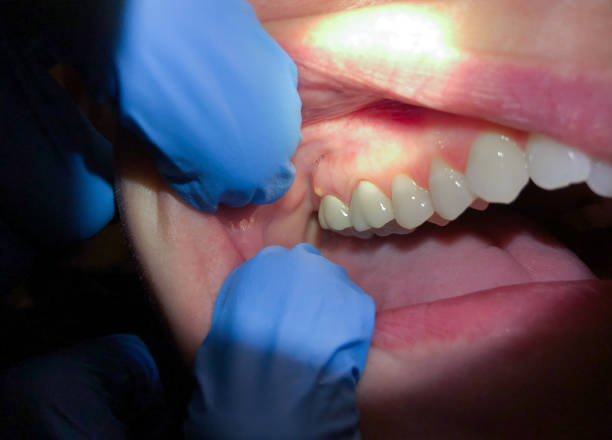 Best Emergency Treatment for Dental Infections or Abscesses in Fresno, TX