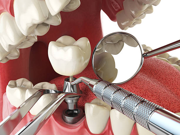 Best Emergency Root Canal Treatment in Fresno, TX