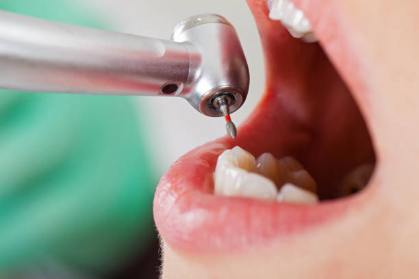 Best Emergency Dental Care for Broken or Chipped Teeth in Fresno, TX